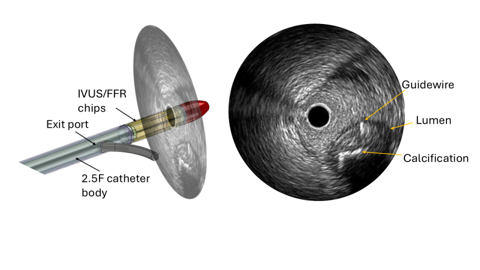 A new kind of catheter designed to give doctors clearer, real-time insight during these life-saving procedures.