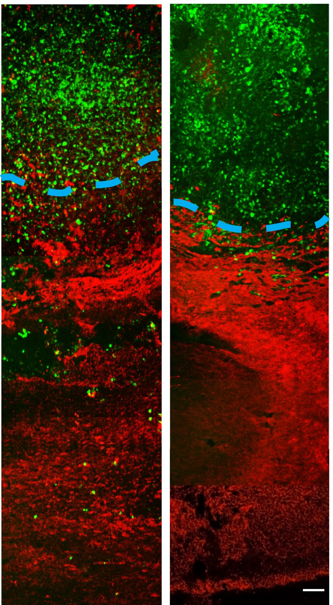 Imipramine blue tumor invasion